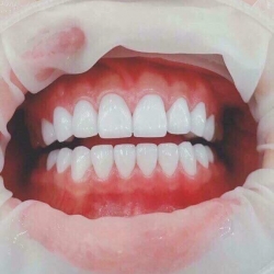 Chỉnh răng đẹp