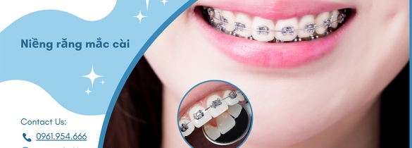 Niềng răng mắc cài bí quyết sở hữu nụ cười hoàn hảo