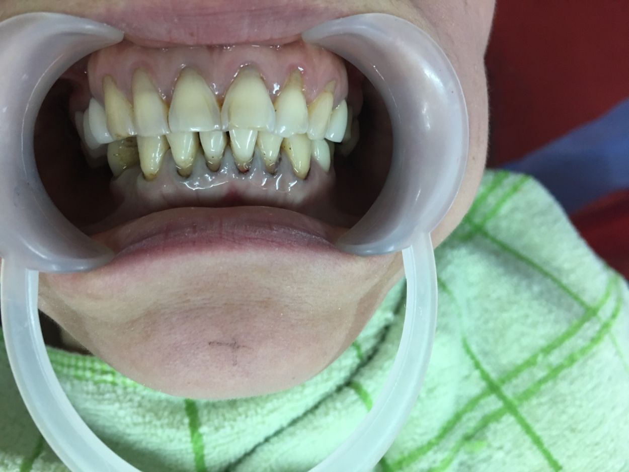 Mặt dán răng sứ Veneers giúp cho bạn có nụ cười hoàn hảo