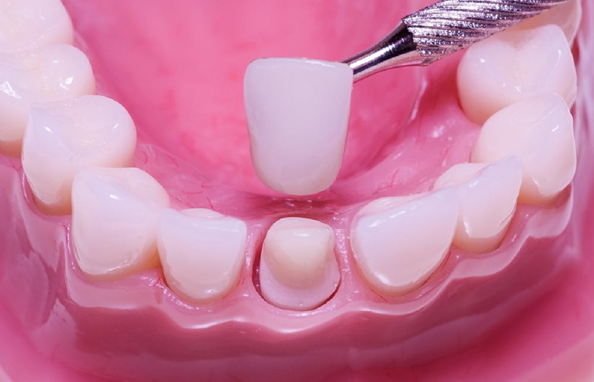 trồng răng giả tại nha khoa uy tín, nha khoa việt pháp