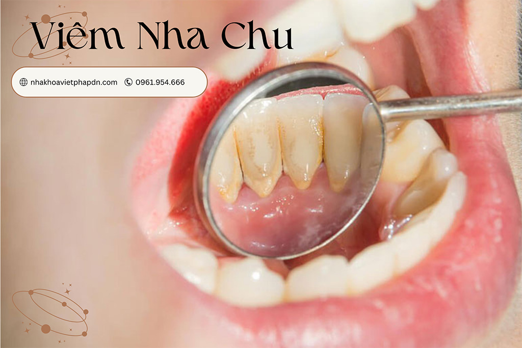 Viêm Nha Chu Các Nguyên Nhân, Triệu Chứng và Điều Trị Hiệu Quả